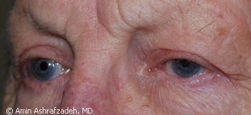 Image of patient after eyelid surgery, blepharoplasty